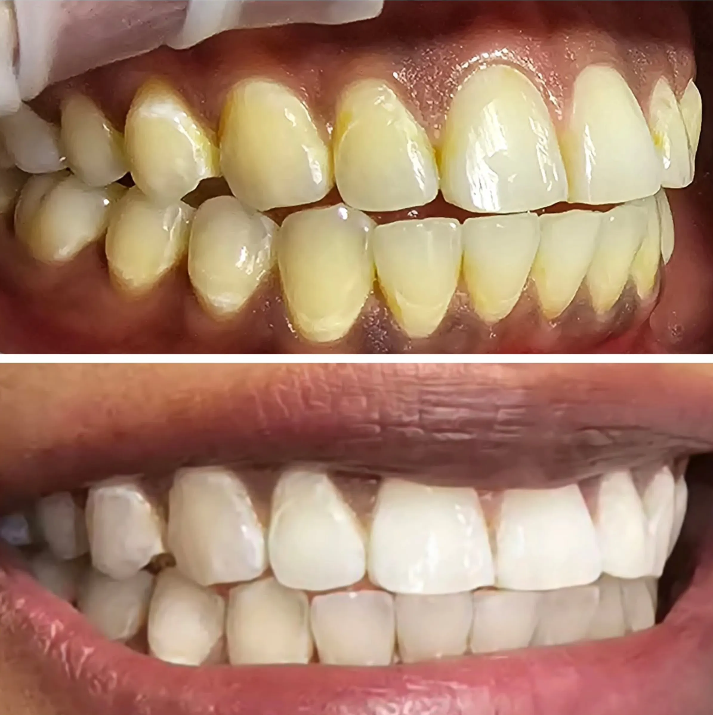 1-day teeth whitening course