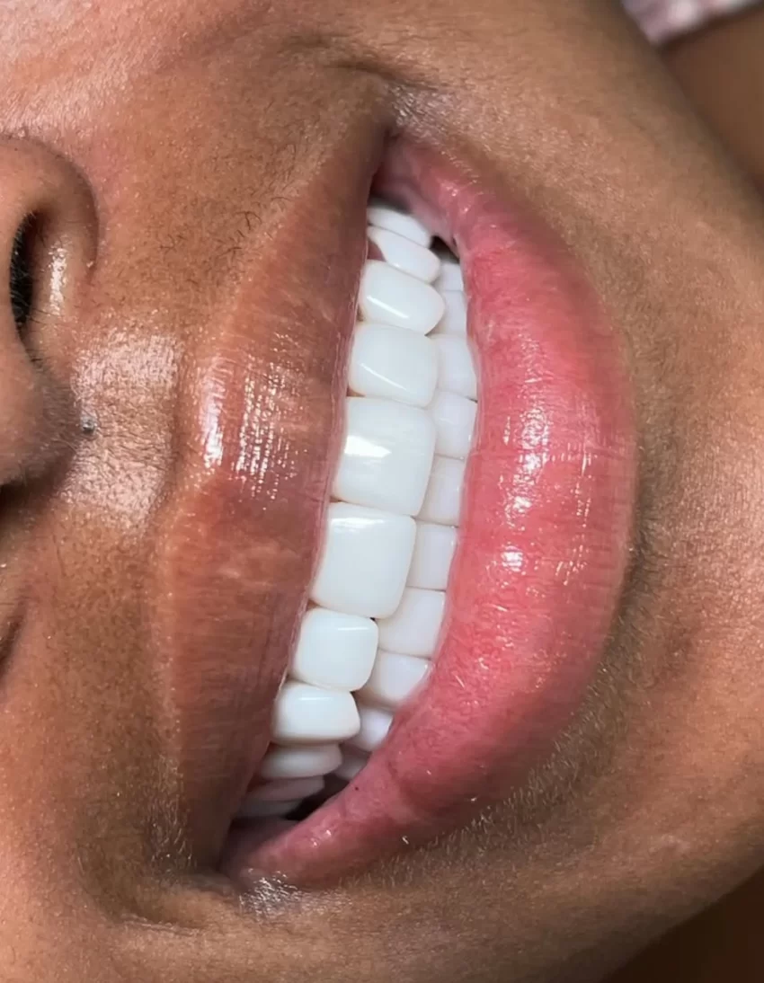 Teeth Whitening Training Time Commitment