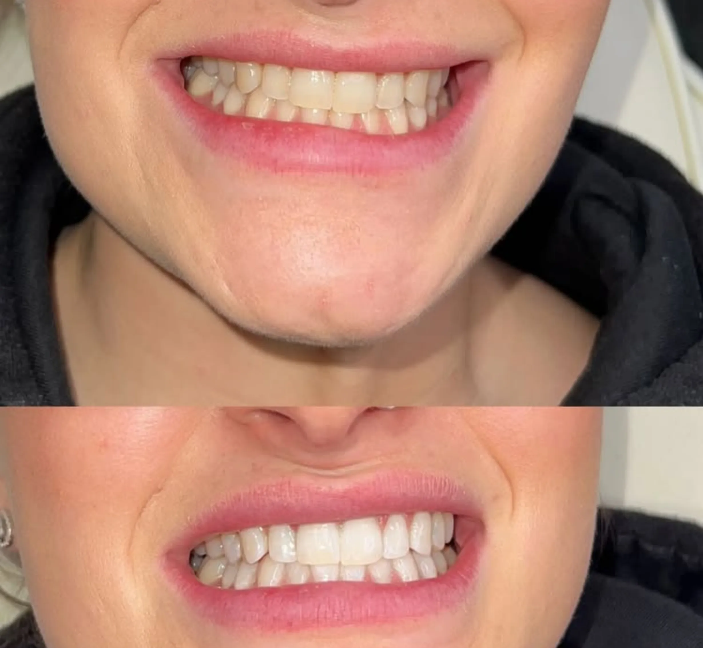 express teeth whitening course