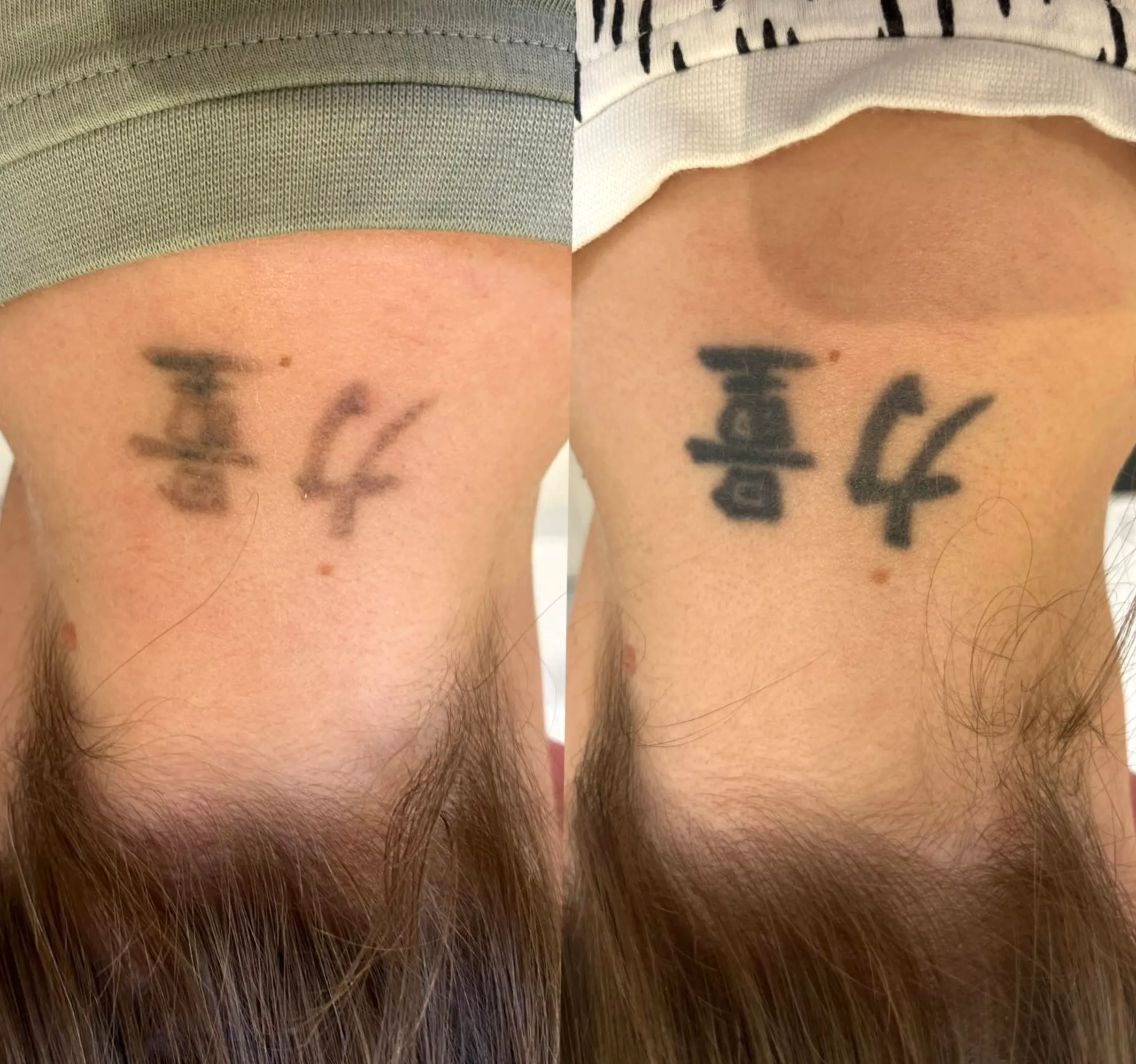 certified tattoo removal courses Australia