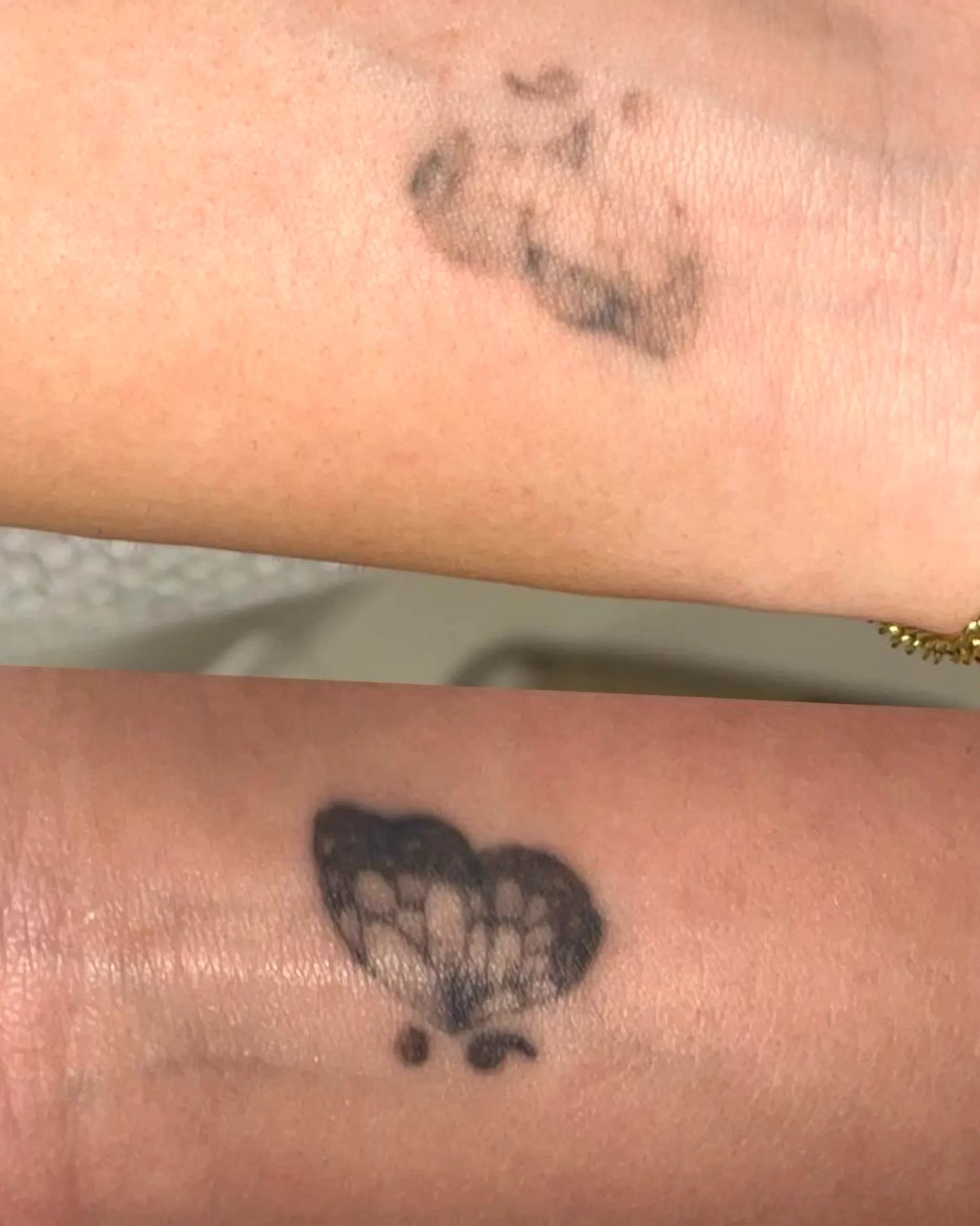 laser safety officer tattoo removal