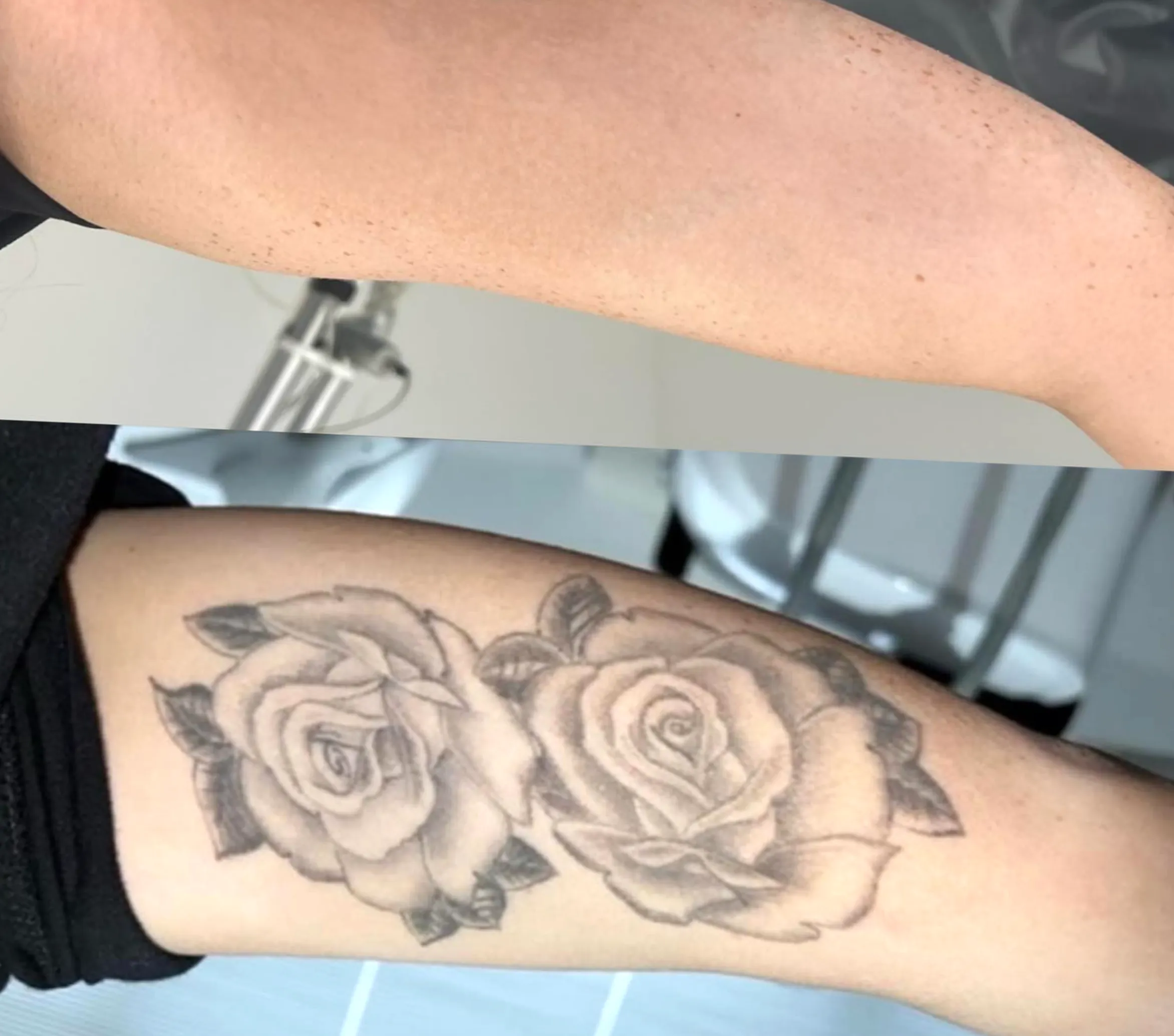laser tattoo removal training Australia