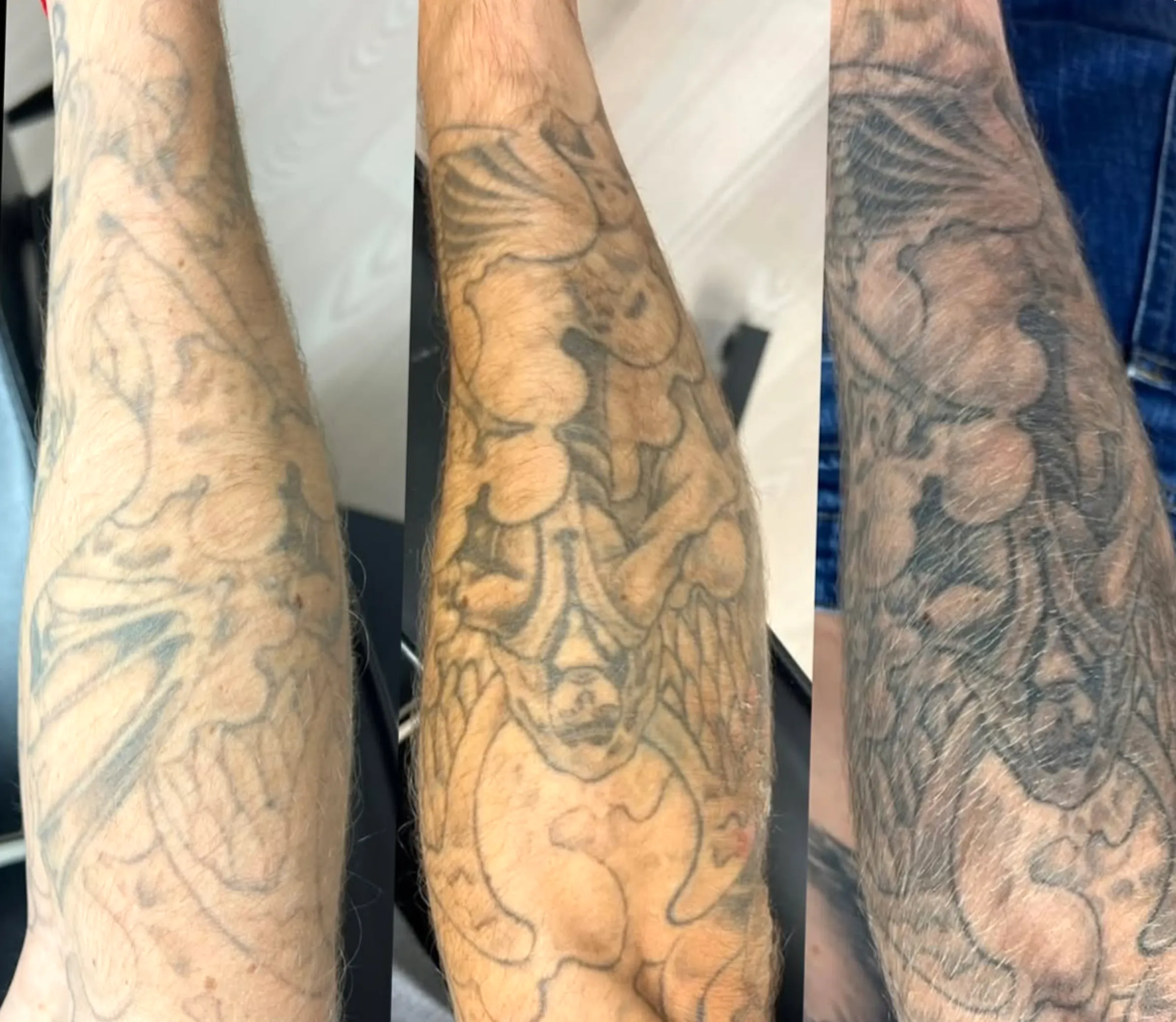 tattoo removal course insurance approved