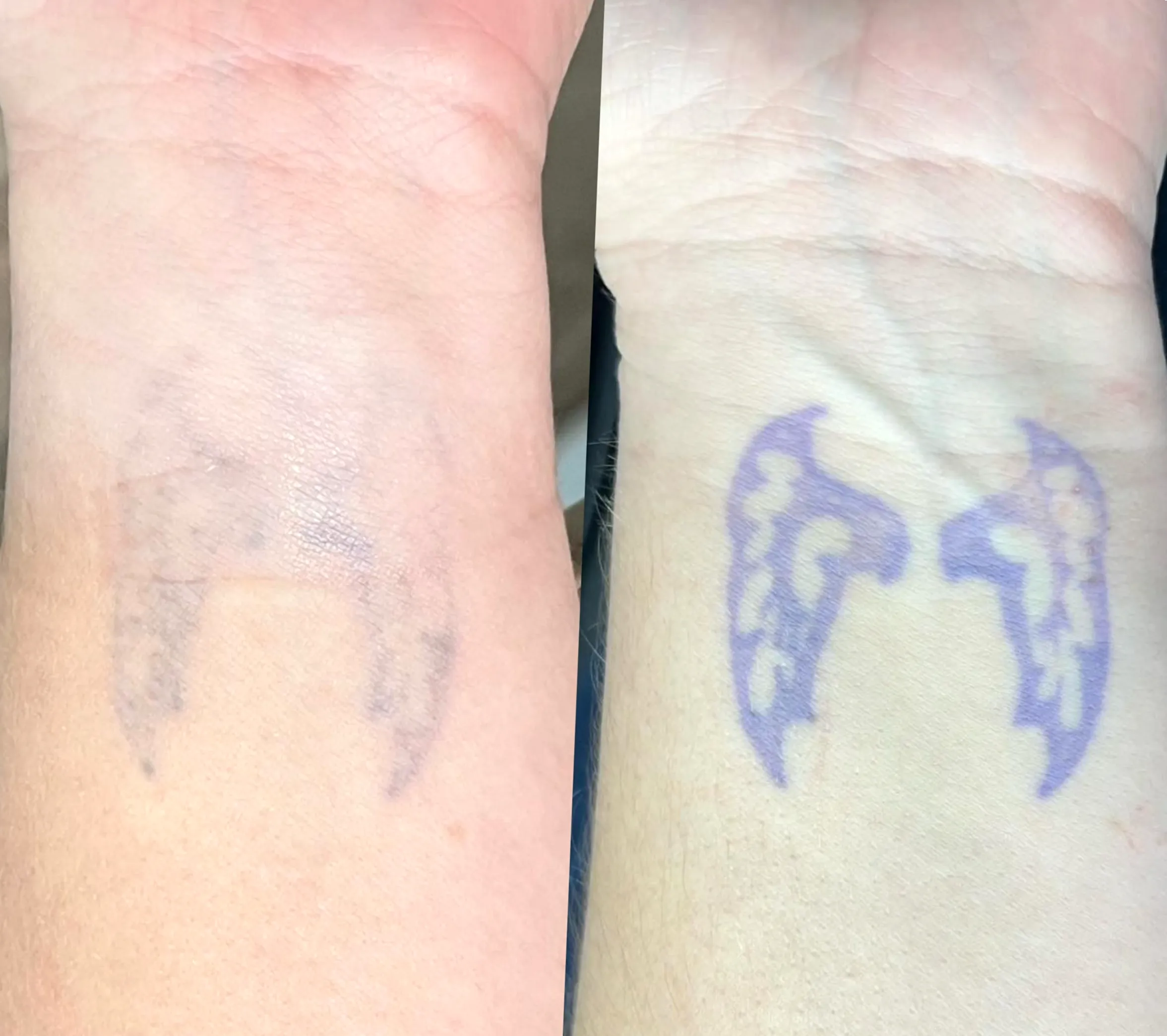 tattoo removal infection control training