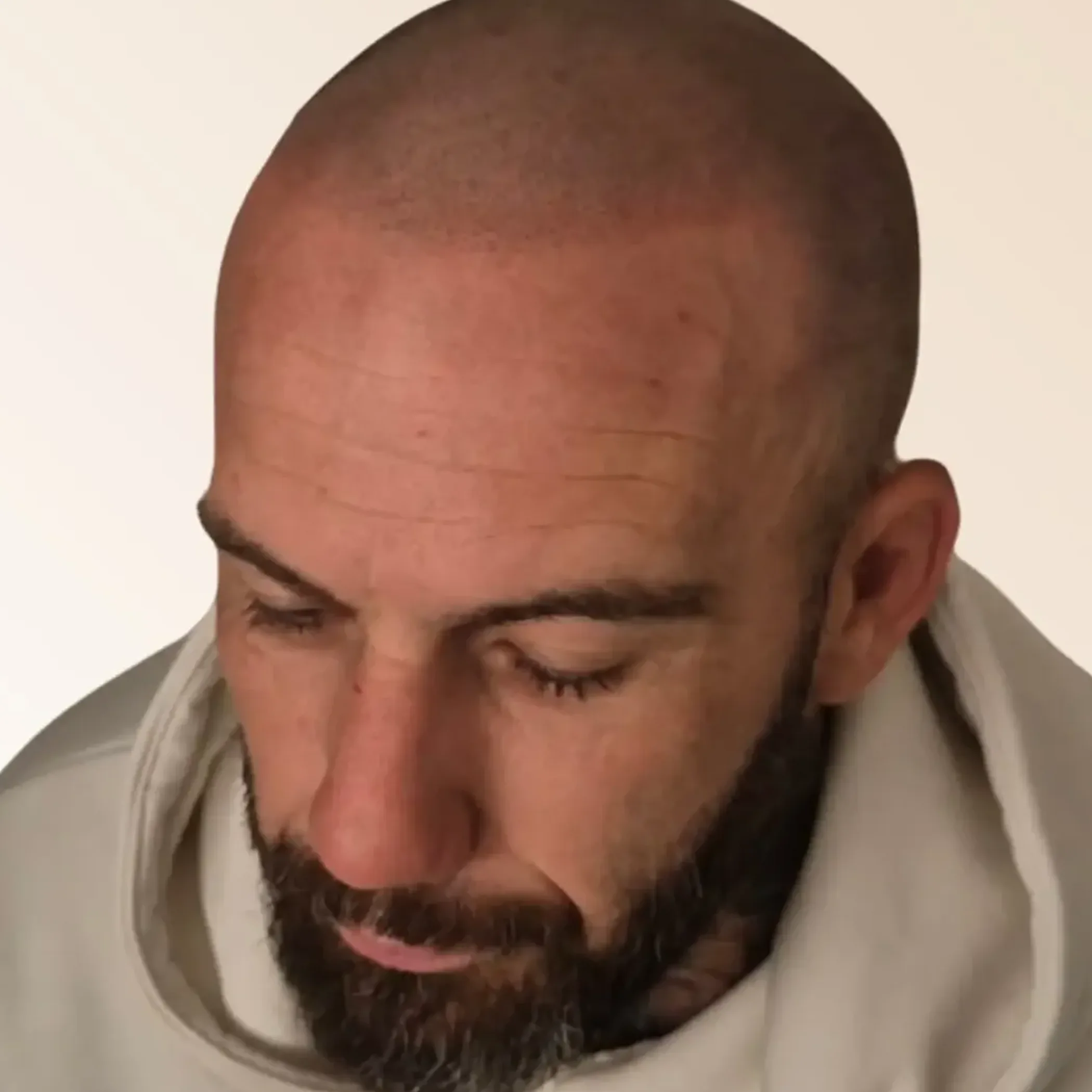 scalp micropigmentation on a real client