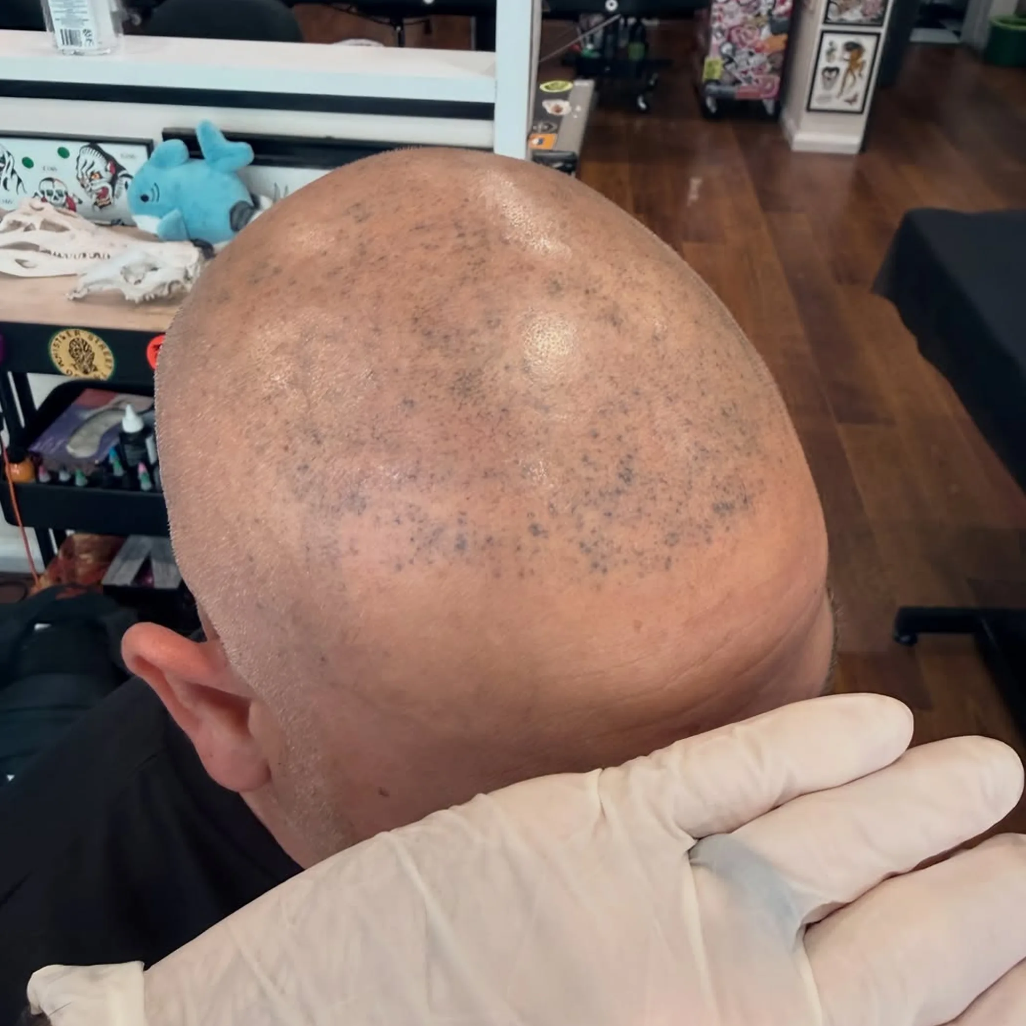 scalp micropigmentation treatment