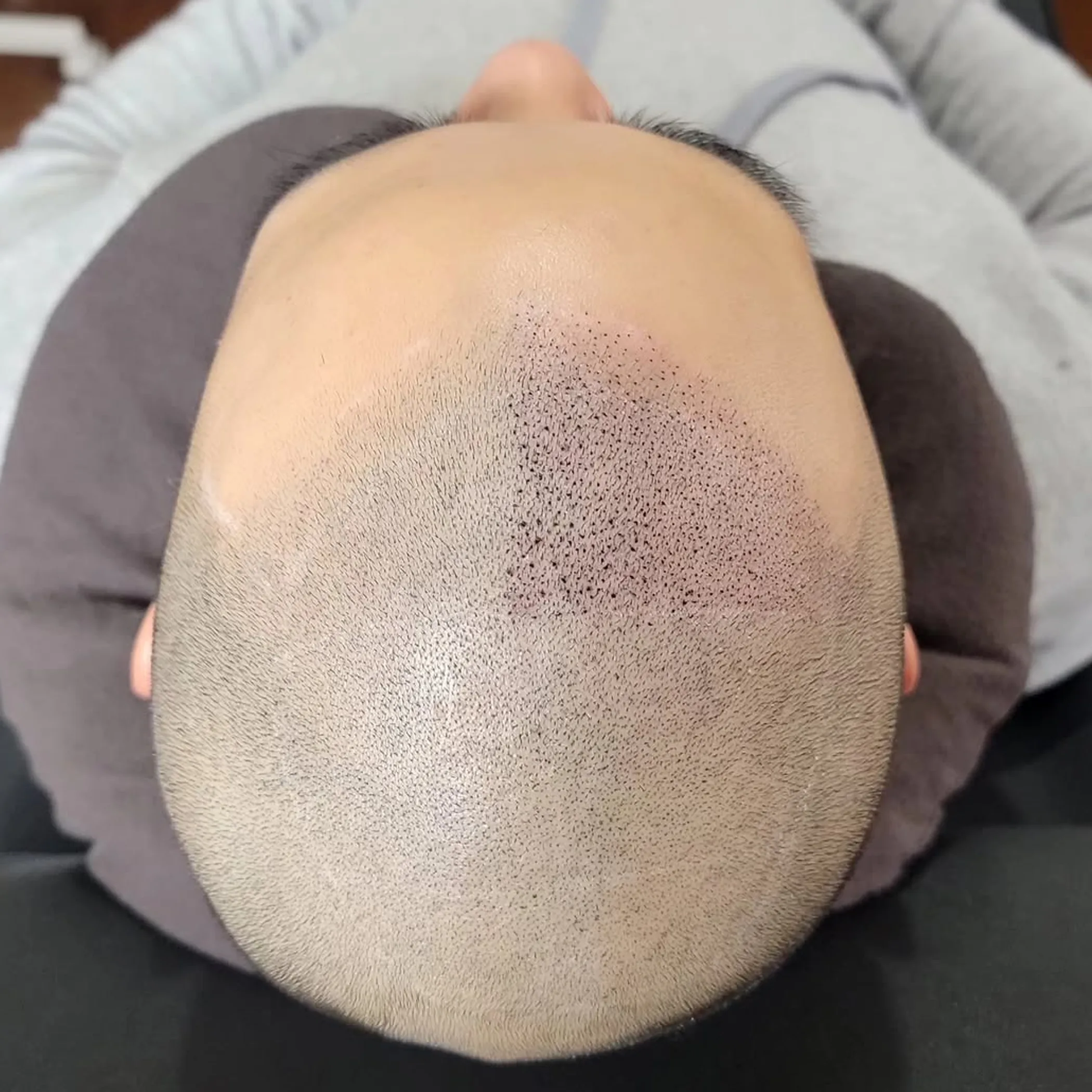 healed scalp micropigmentation impressions